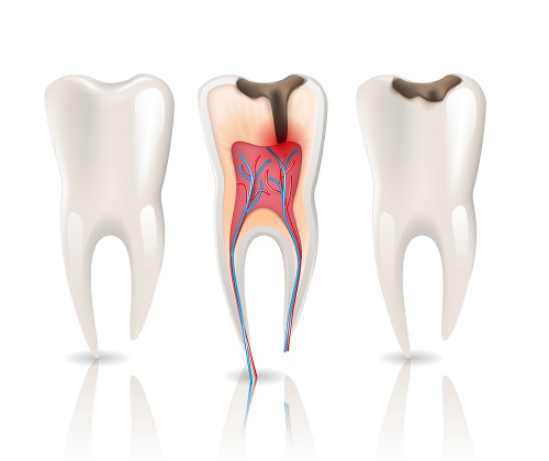 چرا دندان درد میگیرد؟