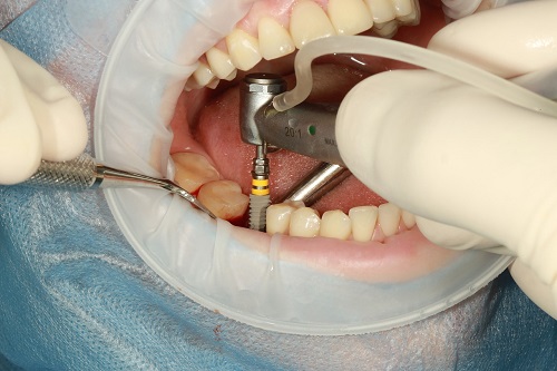 ایمپلنت دندانی کاشت دندان دکتر علی هاشمی سجادی 