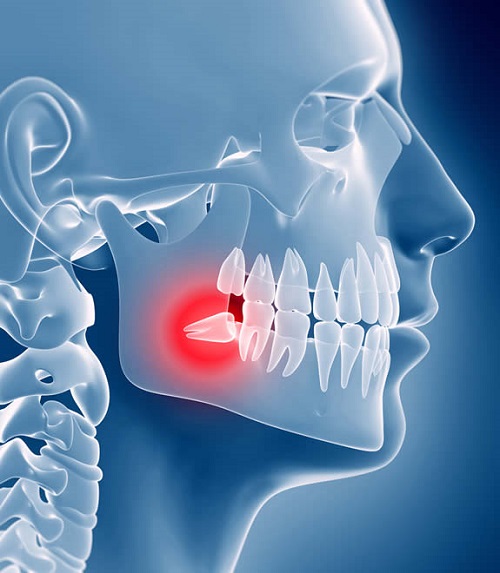 جراحی های دندان و دهان فک و صورت tooth extraction جراحی دندان عقل 