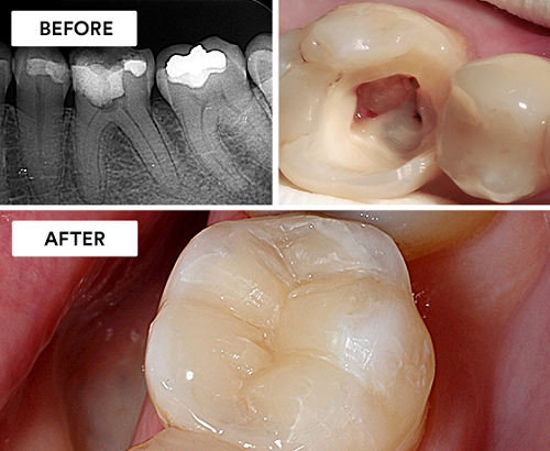 درمان ریشه پوسیده دندان و عصب کشی پوسیدگی دندان