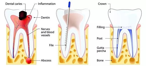 تفاوت درمان ریشه دندان با عصب کشی