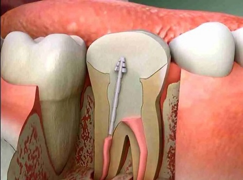 درمان ریشه ترک دندان - عصب کشی ترک دندان