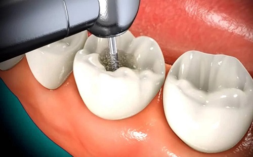 مراحل و روش درمان ریشه دندان (روت کانال)