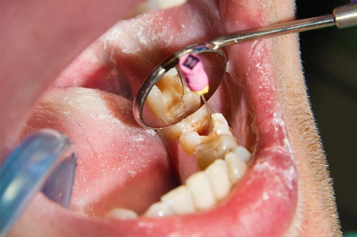 درمان ریشه دندان چقدر طول میکشد عصب کشی چند جلسه زمان میبرد