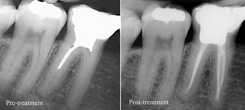 عصب کشی و پرکردن دندان