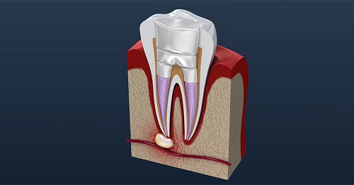 کیست ریشه دندان یا درمان ضایعه ریشه دندان