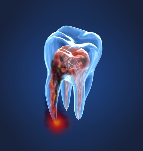 درمان ریشه دندان تا چند روز درد دارد؟