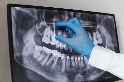 حوادث حین درمان ریشه دندان