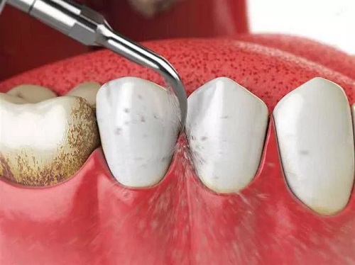 بلیچینگ و جرمگیری دندان سفید کردن دندان bleaching