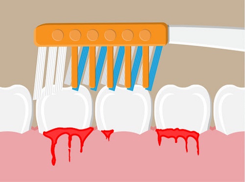 بلیچینگ و جرمگیری دندان سفید کردن دندان bleaching 