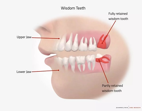 جراحی دندان عقل دندان 8 wisdom teeth دندان عقل نهفته دندان عقل نیمه نهفته