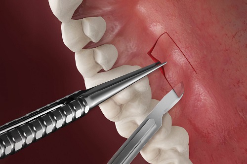 جراحی لثه یا پریودنتال سرجریperiodontal surgery