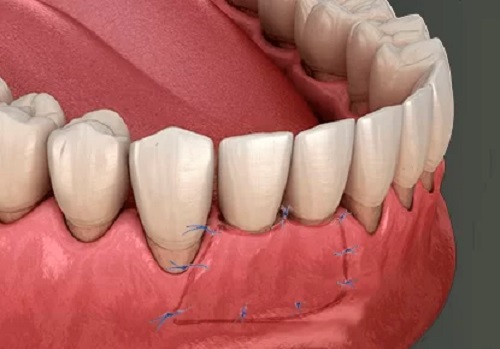 جراحی لثه یا پریودنتال سرجریperiodontal surgery