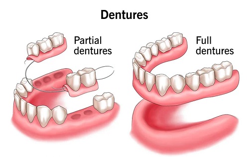 پروتز دندانی ثابت پروتز دندانی متحرک Dental Prosthesis denture overdenture