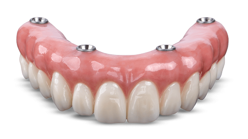 پروتز های متصل به ایپلنت اوردنچر overdenture پروتز ثابت و متحرک دندان 