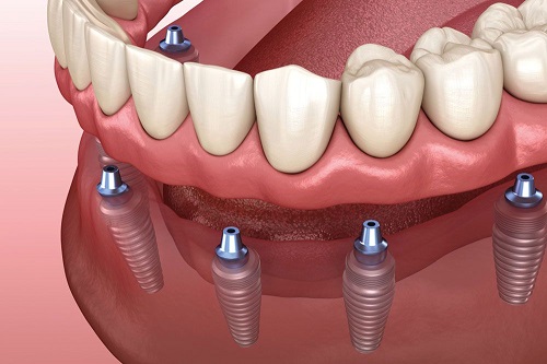 پروتز های متصل به ایپلنت اوردنچر overdenture پروتز ثابت و متحرک دندان 