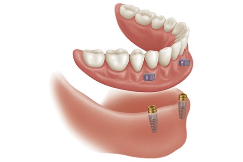 پروتز های متصل به ایپلنت پروتز ثابت و متحرک دندان