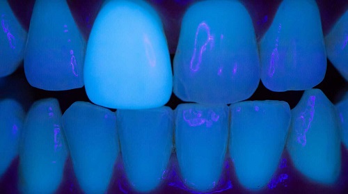 کامپوزیت ونیر سرامیک دندان