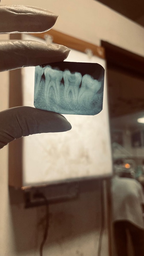 عکس رادیوگرافی دندانی xray دندان عکس دندان