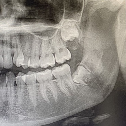 عکس رادیوگرافی دندانی xray دندان عکس دندان