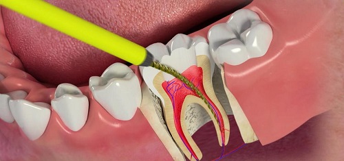 عصب کشی دندان روت کانال تراپی اندودنتیکس