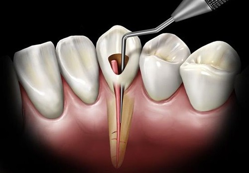 عصب کشی دندان روت کانال تراپی اندودنتیکس