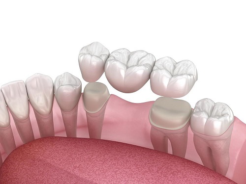 ایمپلنت دندانی یا پل و بریج دندان