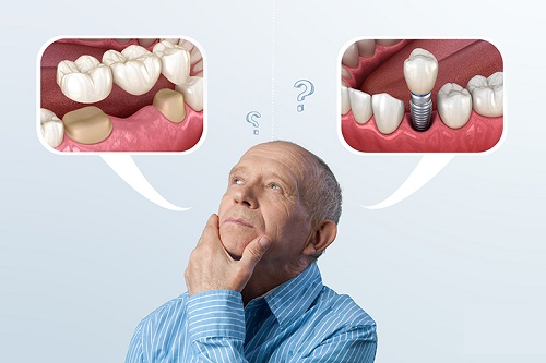 ایمپلنت دندانی یا پل و بریج دندان