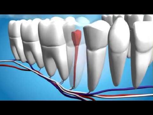 عصب کشی دندان روت کانال تراپی اندودنتیکس 