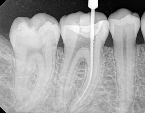 عصب کشی دندان روت کانال تراپی اندودنتیکس 