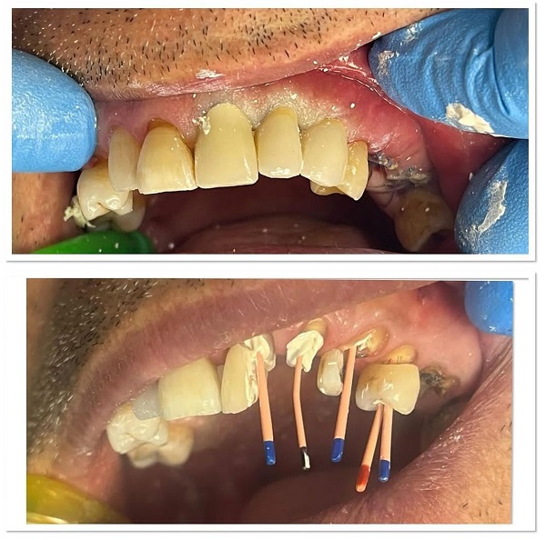 عصب کشی دو کانال درمان ریشه دندان