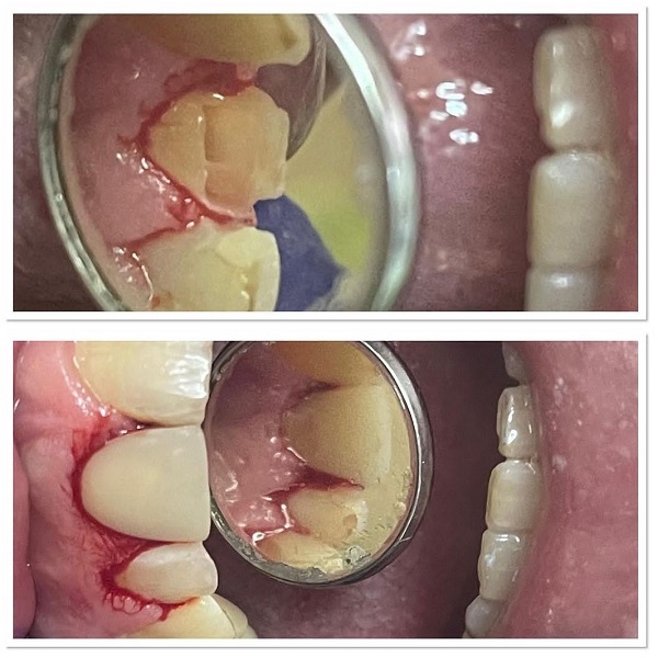 ترمیم و بازسازی دندان قدامی توسط کامپوزیت نوری