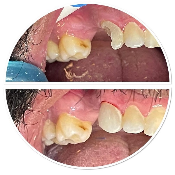 ترمیم و بازسازی دندان تخریب شده توسط کامپوزیت دندانی
