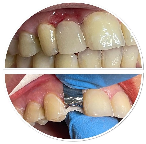 ترمیم کامپوزیت دندان 3 بالا کامپوزیت ونیر لمینیت دندان بازسازی تاج دندان
