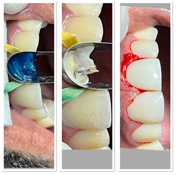 بازسازی دندان تخریب شده ترمیم دندان پوسیده