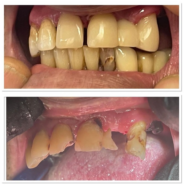 بازسازی کامل دندان پوسیده ترمیم کامپوزیت پست و روکش دندان