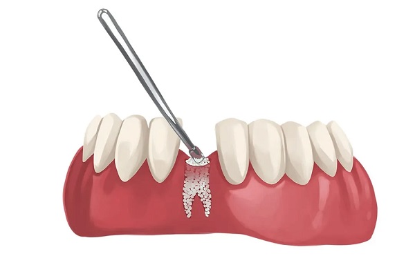 پیوند استخوان قبل از ایمپلنت دندان