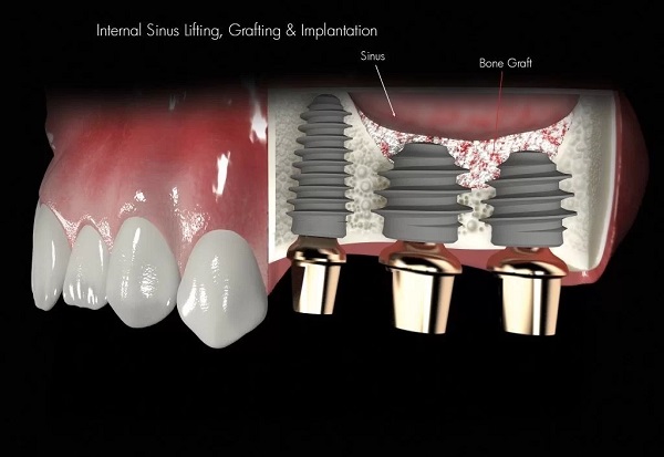کاشت دندان و ایمپلنت دندانی
