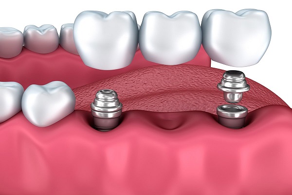 دندان مصنوعی و مراقبت از ایملنت دندانی 