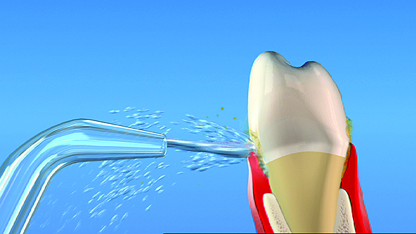 بهداشت دهان و دندان پس از انجام ایمپلنت دندان