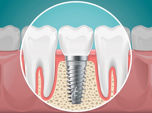 جوش خوردن ایمپلنت دندان ترکیب بافت استخوان با ایمپلنت دندان
