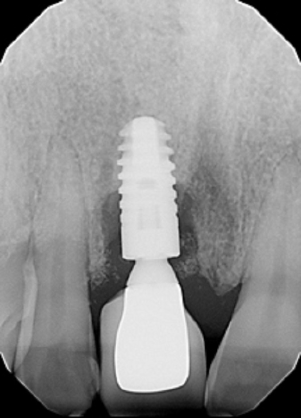 ترکیب شدن ایمپلنت با استخوان فک کاشت دندان و ایمپلنت دندانی