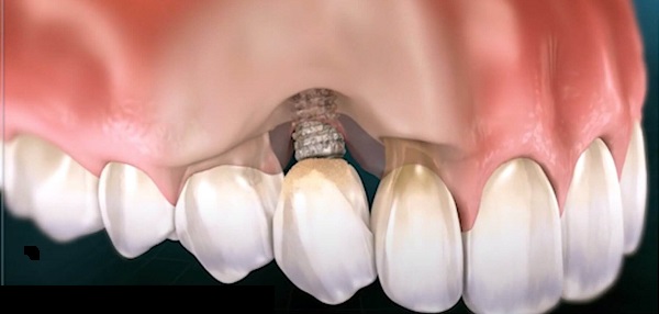 عفونت ایمپلنت دندان عفونت لثه جراحی ایمپلنت و عفونت