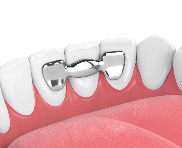 جایگزین ایمپلنت دندانی جایگزین کاشت دندان پروتز ثابت پروتز متحرک