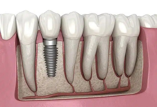 ایمپلنت و بافت استخوان پوکی استخوان و کاشت دندان