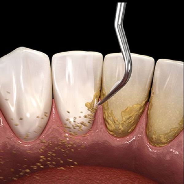 جرمگیری دندان چقدر اهمیت دارد؟