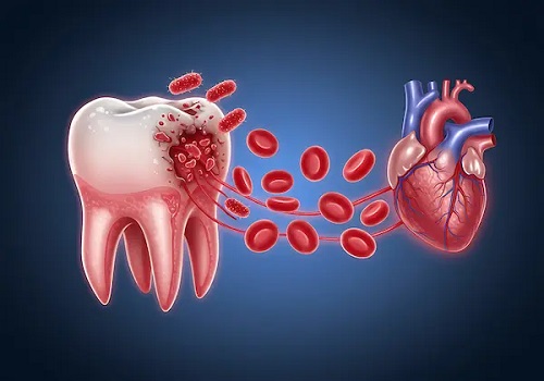  آیا عفونت دندان هم خطر قلبی دارد؟